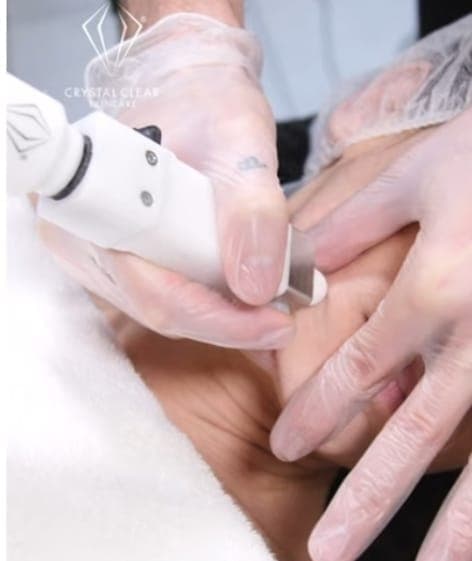 Microdermabrasie op het gelaat